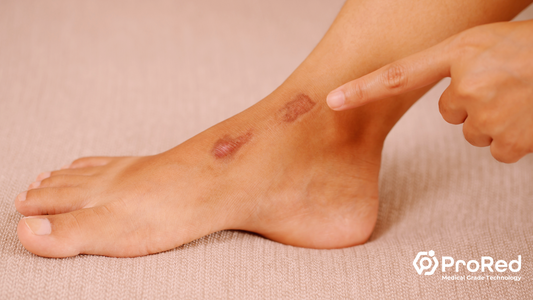 Red Light Therapy for Wound Healing: Accelerating Recovery with ProRed