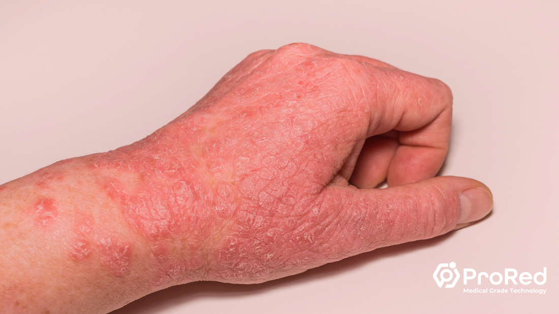 Red Light Therapy for Psoriasis and Eczema: A Natural Approach to Skin Conditions